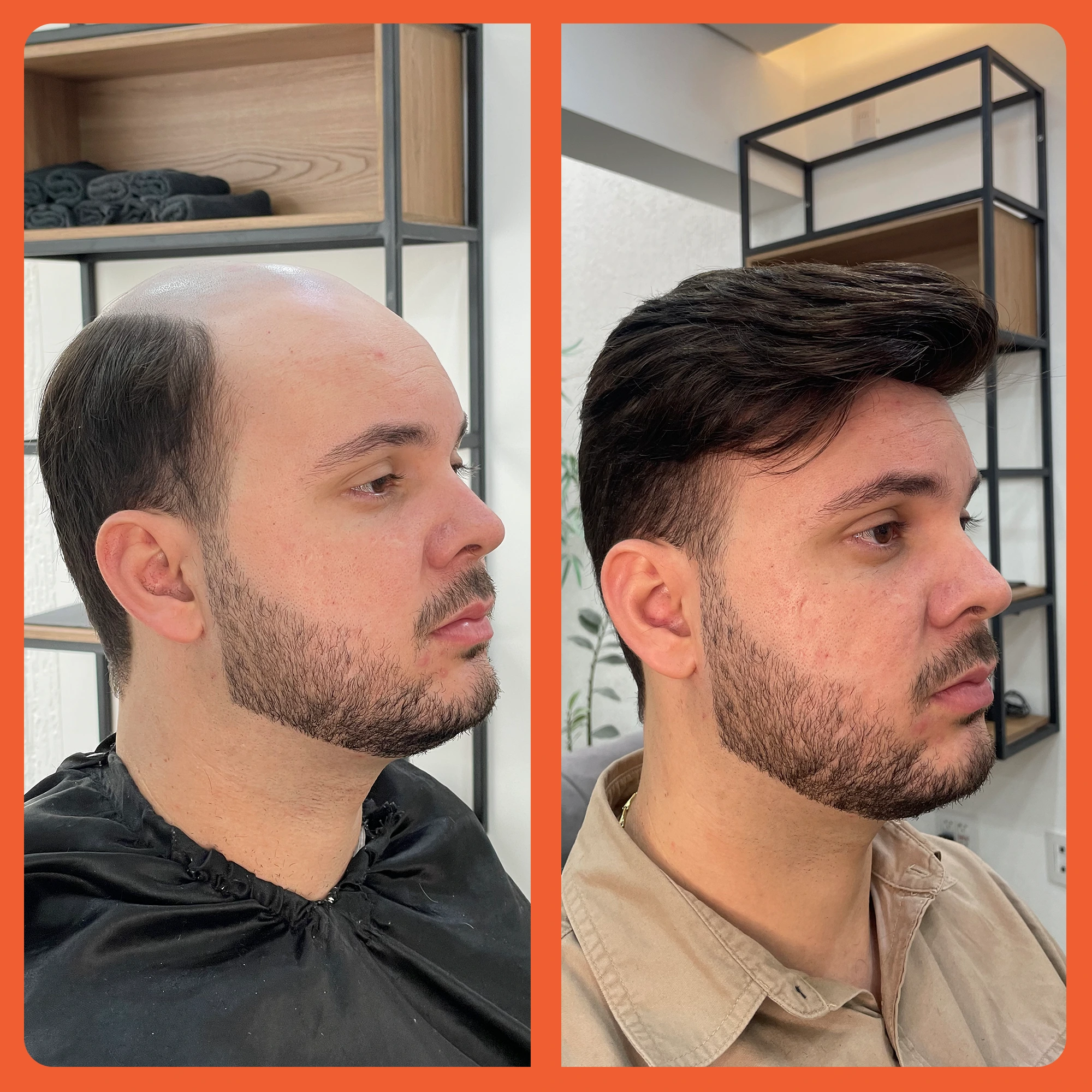 mostrar o antes e depois do uso da prótese capilar