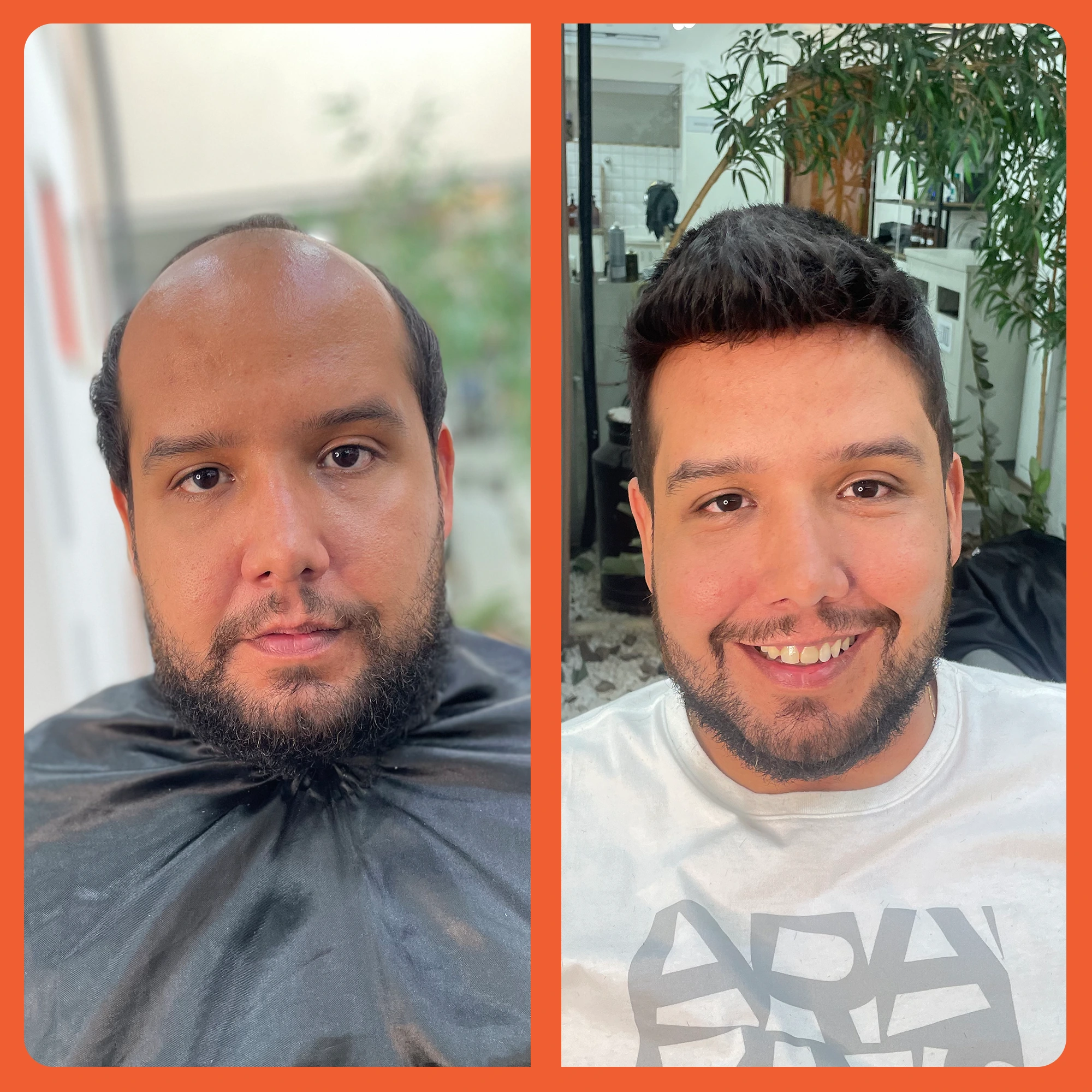 mostrar o antes e depois do uso da prótese capilar