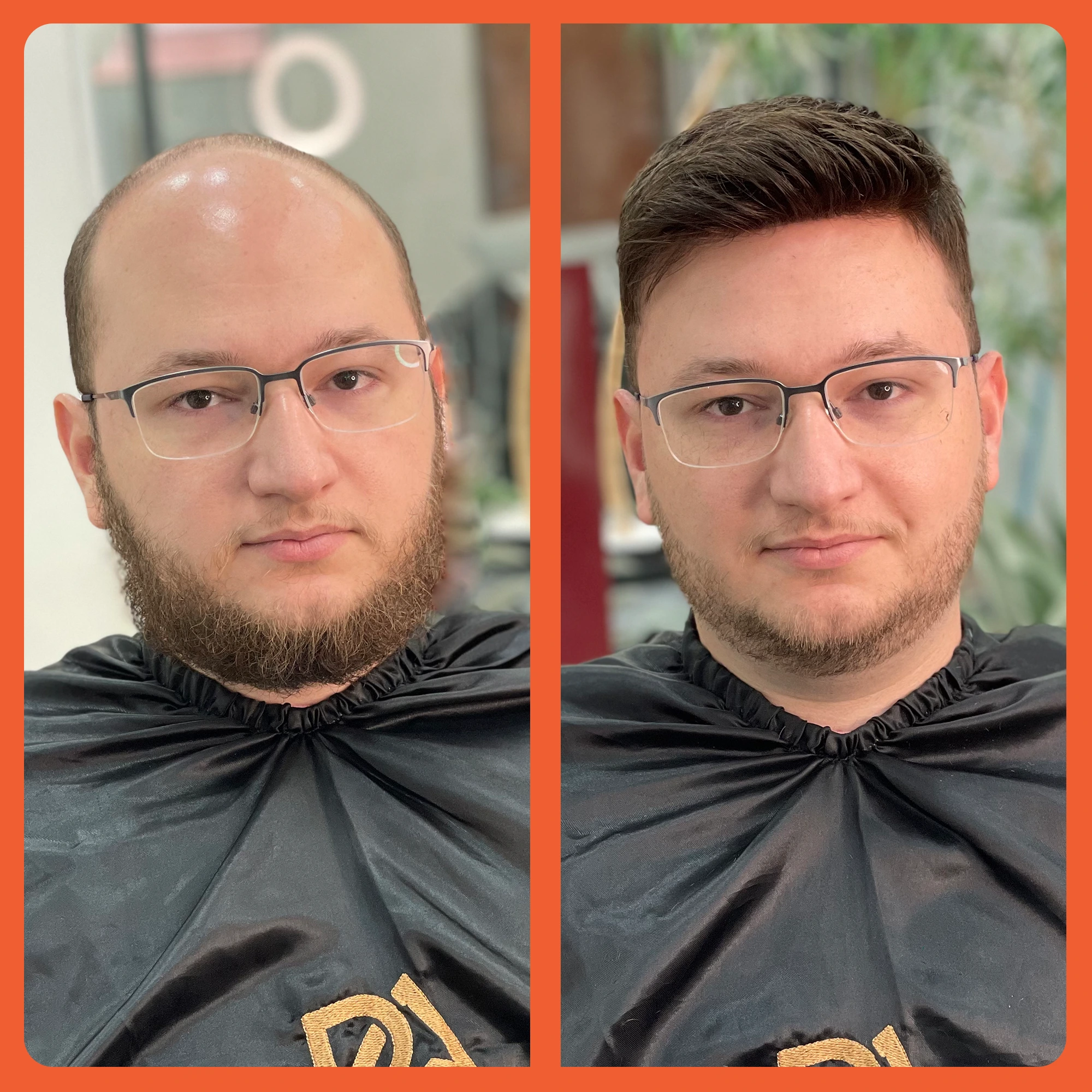mostrar o antes e depois do uso da prótese capilar