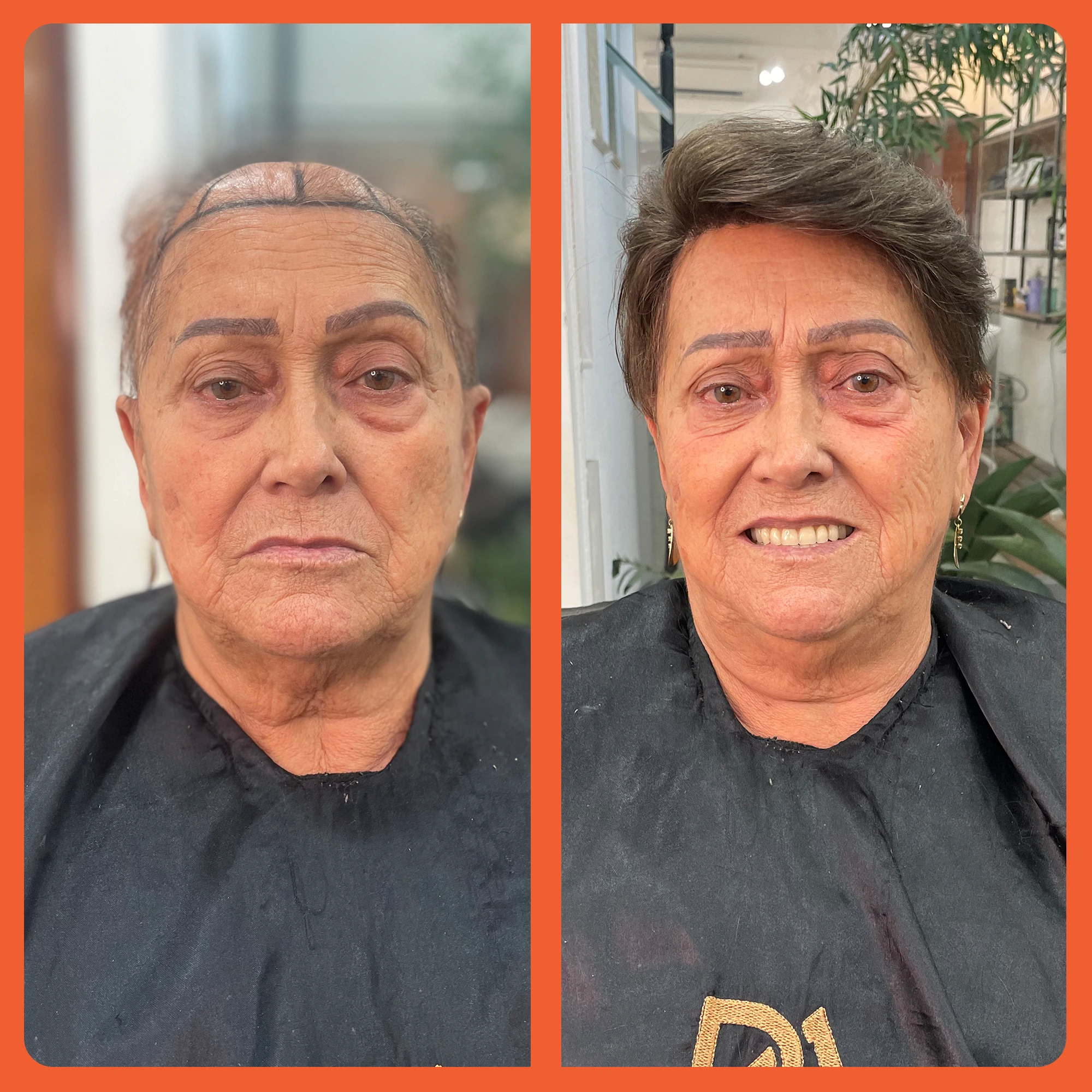 mostrar o antes e depois do uso da prótese capilar em mulheres